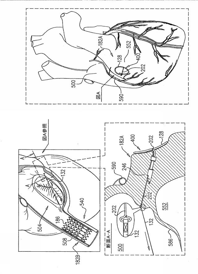 6816889-引張り部材を有する偏心組織アンカー 図000041