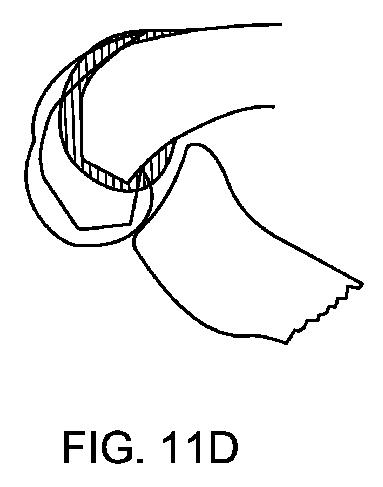 5837876-人工膝患者に深膝屈曲能力を提供するシステム及び方法 図000042