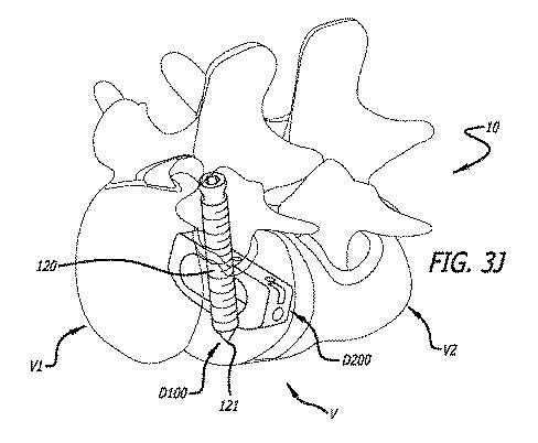 6475762-複数の脊椎外科的経路システムおよび方法 図000043