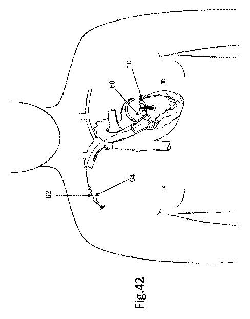 6153938-心臓弁修復デバイス 図000045