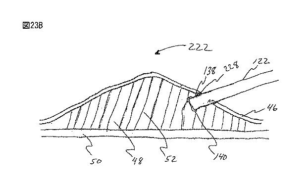 6235672-粘膜下医療処置を実行するための方法及びシステム 図000047