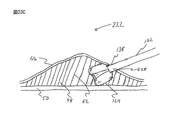 6235672-粘膜下医療処置を実行するための方法及びシステム 図000048