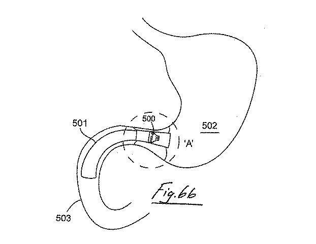 6853312-内腔プロテーゼおよび胃腸インプラントデバイス 図000067