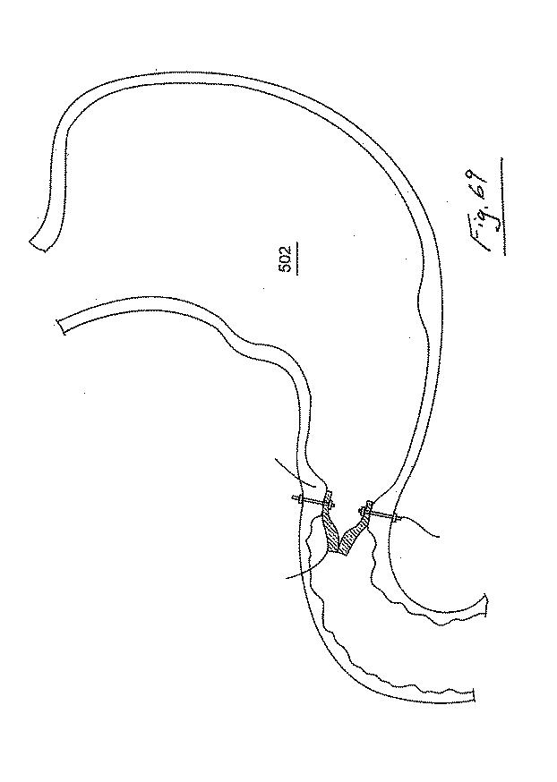 6853312-内腔プロテーゼおよび胃腸インプラントデバイス 図000070