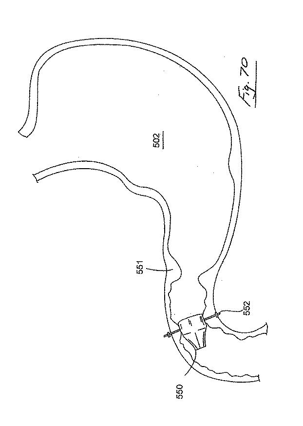 6853312-内腔プロテーゼおよび胃腸インプラントデバイス 図000071