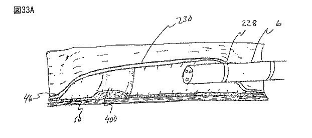 6235672-粘膜下医療処置を実行するための方法及びシステム 図000073