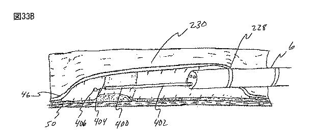 6235672-粘膜下医療処置を実行するための方法及びシステム 図000074