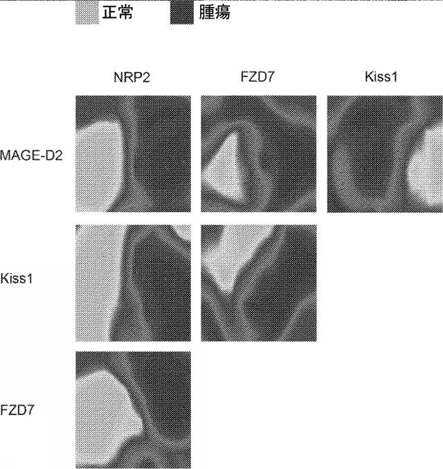 6321233-胃腸膵神経内分泌新生物（ＧＥＰ−ＮＥＮ）の予測方法 図000074