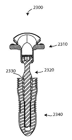 5892446-二重束ＡＣＬ修復システム 図000075