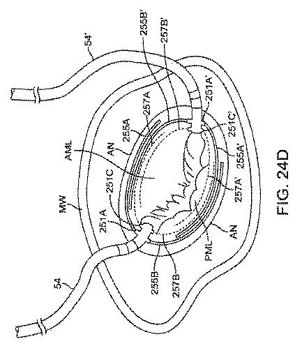 6010545-僧帽弁の修復および置換のためのシステム 図000075