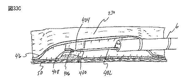 6235672-粘膜下医療処置を実行するための方法及びシステム 図000075