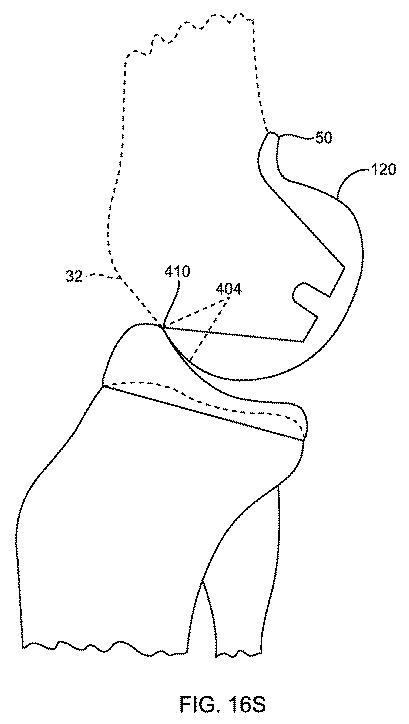 5837876-人工膝患者に深膝屈曲能力を提供するシステム及び方法 図000076