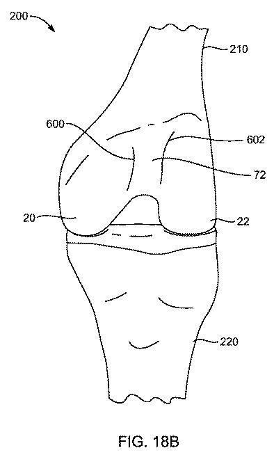 5837876-人工膝患者に深膝屈曲能力を提供するシステム及び方法 図000079