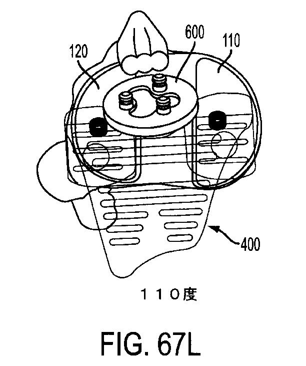 6161900-十字靭帯温存型人工膝関節 図000079