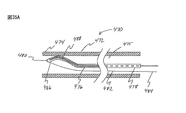 6235672-粘膜下医療処置を実行するための方法及びシステム 図000079