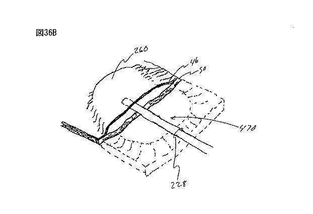 6235672-粘膜下医療処置を実行するための方法及びシステム 図000083