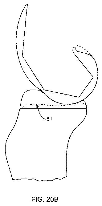 5837876-人工膝患者に深膝屈曲能力を提供するシステム及び方法 図000084