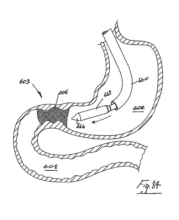 6853312-内腔プロテーゼおよび胃腸インプラントデバイス 図000085