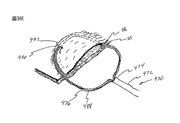 6235672-粘膜下医療処置を実行するための方法及びシステム 図000086