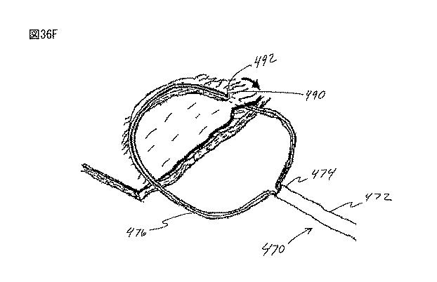 6235672-粘膜下医療処置を実行するための方法及びシステム 図000087