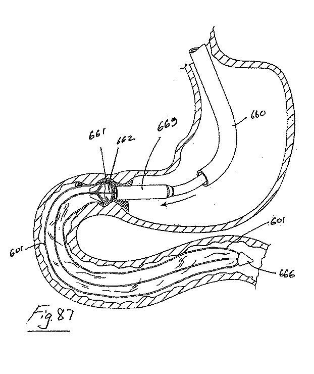 6853312-内腔プロテーゼおよび胃腸インプラントデバイス 図000088