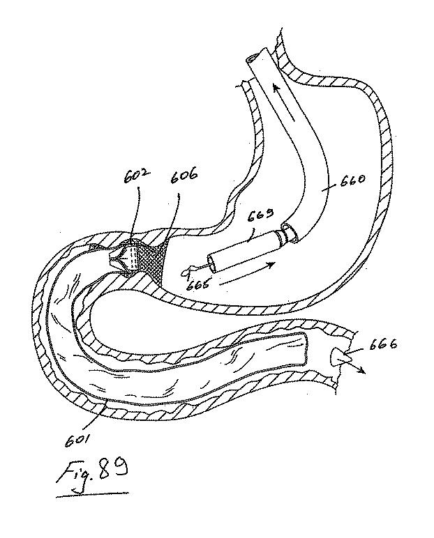 6853312-内腔プロテーゼおよび胃腸インプラントデバイス 図000090