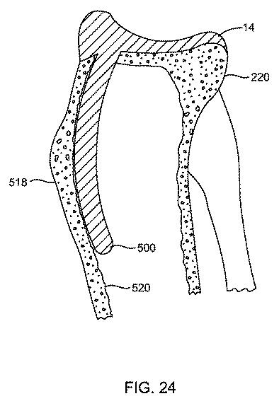 5837876-人工膝患者に深膝屈曲能力を提供するシステム及び方法 図000097