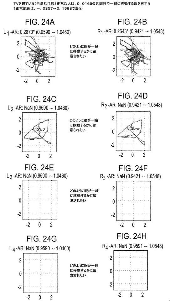 6676522-対象における眼球運動を追跡するためのデバイスの作動方法、および当該デバイスによって追跡された眼球運動のデータの中枢神経系病変を位置特定するための使用方法 図000106