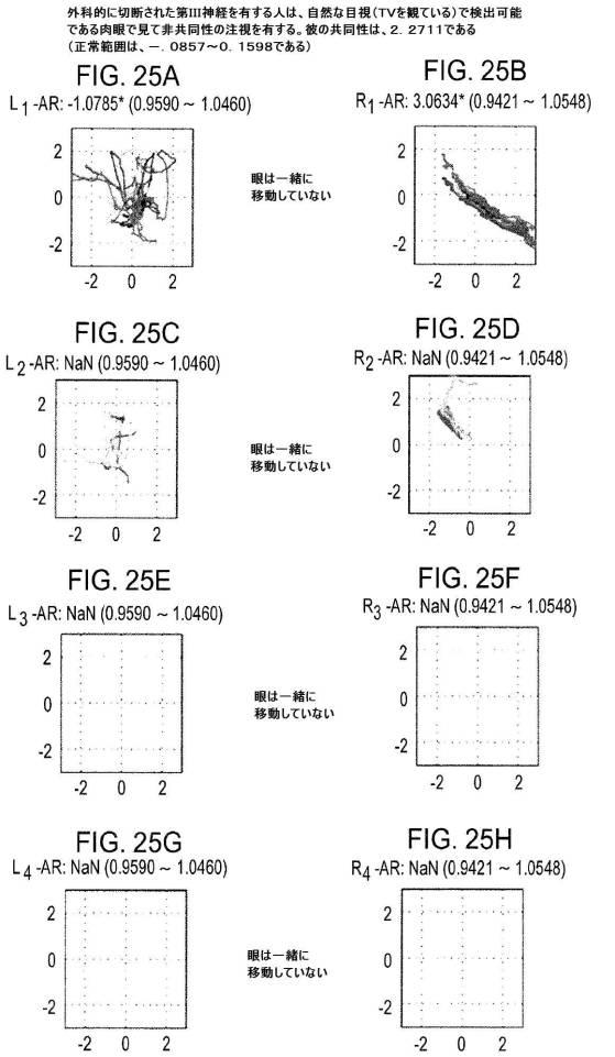 6676522-対象における眼球運動を追跡するためのデバイスの作動方法、および当該デバイスによって追跡された眼球運動のデータの中枢神経系病変を位置特定するための使用方法 図000109