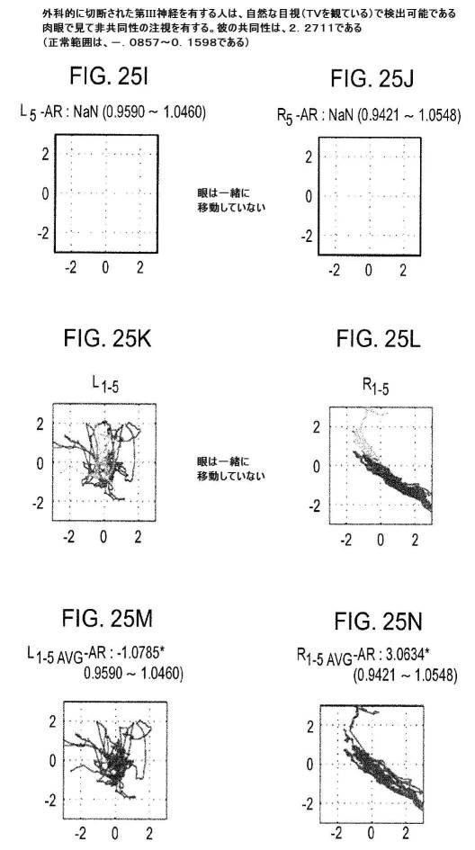 6676522-対象における眼球運動を追跡するためのデバイスの作動方法、および当該デバイスによって追跡された眼球運動のデータの中枢神経系病変を位置特定するための使用方法 図000110