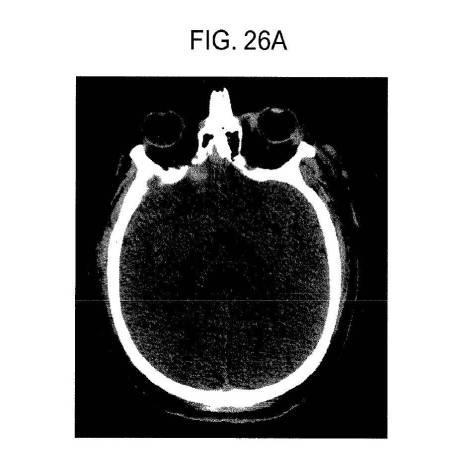 6676522-対象における眼球運動を追跡するためのデバイスの作動方法、および当該デバイスによって追跡された眼球運動のデータの中枢神経系病変を位置特定するための使用方法 図000112