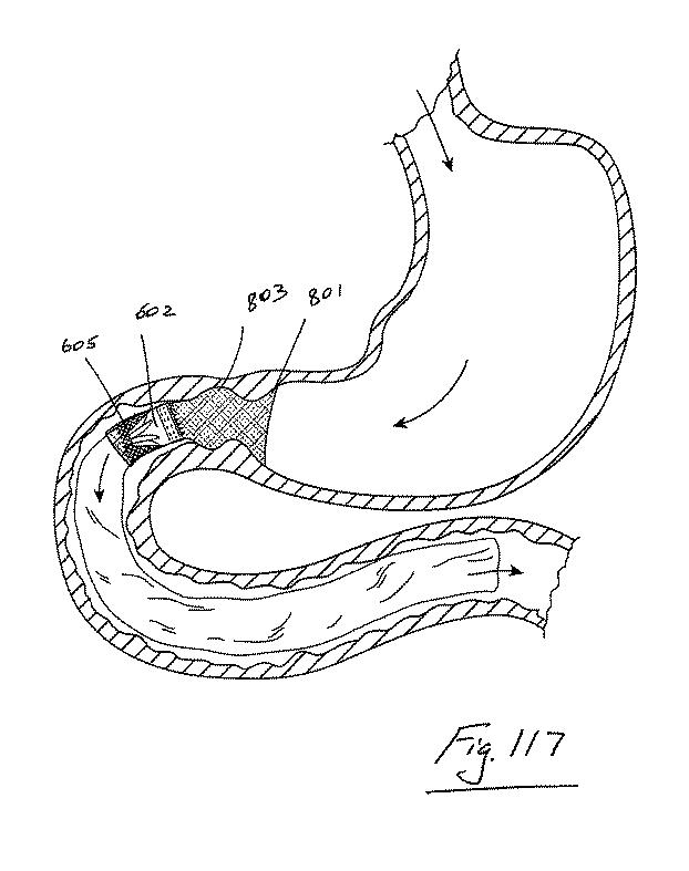 6853312-内腔プロテーゼおよび胃腸インプラントデバイス 図000117