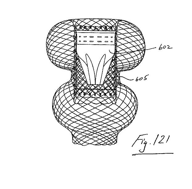 6853312-内腔プロテーゼおよび胃腸インプラントデバイス 図000121
