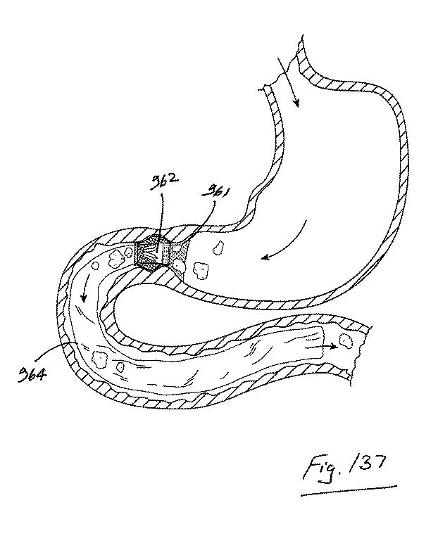 6853312-内腔プロテーゼおよび胃腸インプラントデバイス 図000137