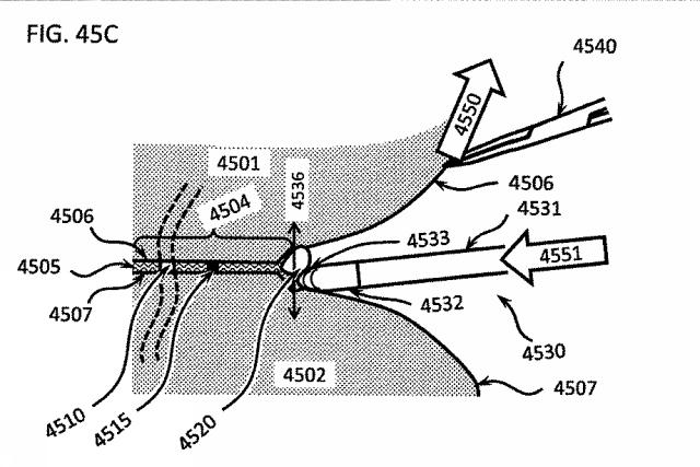 6580038-軟組織切開するための方法及び装置 図000145