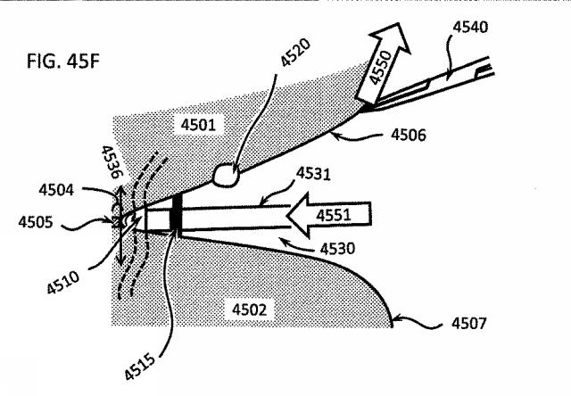 6580038-軟組織切開するための方法及び装置 図000148