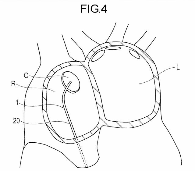 WO2018163899-穿刺デバイス、医療デバイスおよび処置方法 図000007