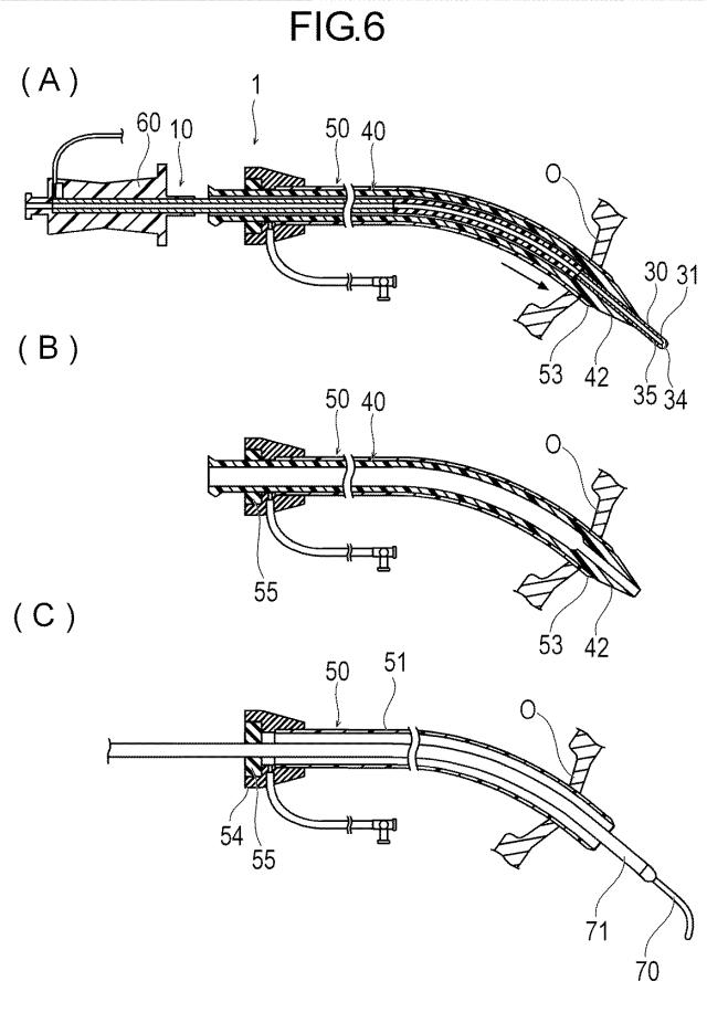 WO2018163899-穿刺デバイス、医療デバイスおよび処置方法 図000009