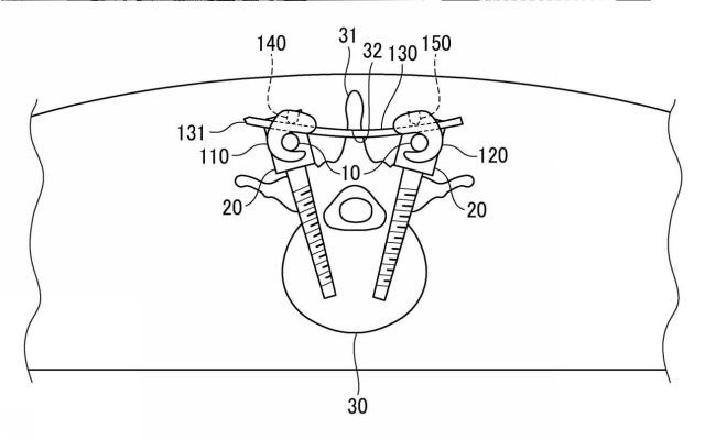 WO2017141459-トランスバース、および手術器具 図000021