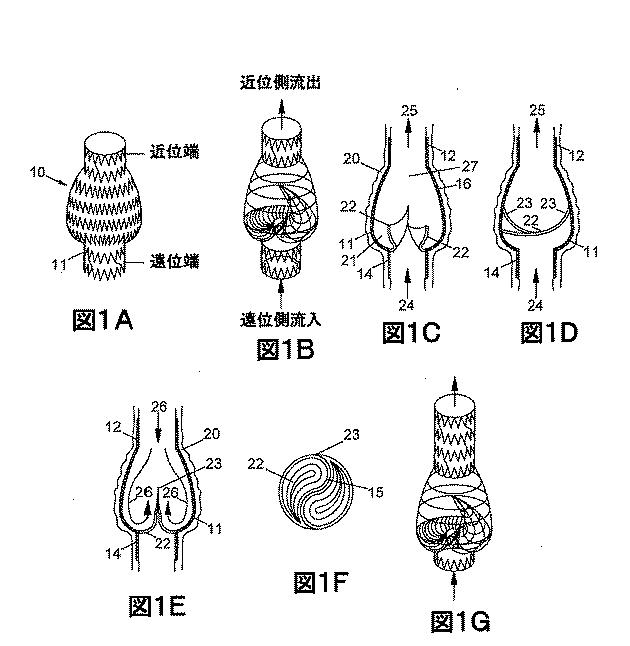 2018530386-植え込み可能弁及び方法 図000003