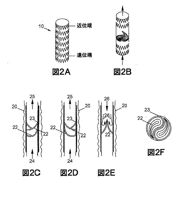 2018530386-植え込み可能弁及び方法 図000004