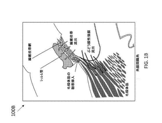 2020521612-低侵襲性緑内障外科手術デバイス、システム、および関連方法 図000004