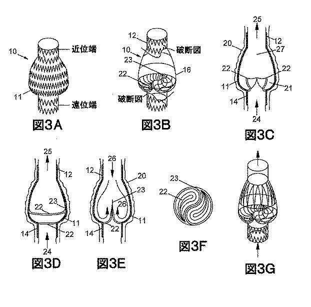 2018530386-植え込み可能弁及び方法 図000005