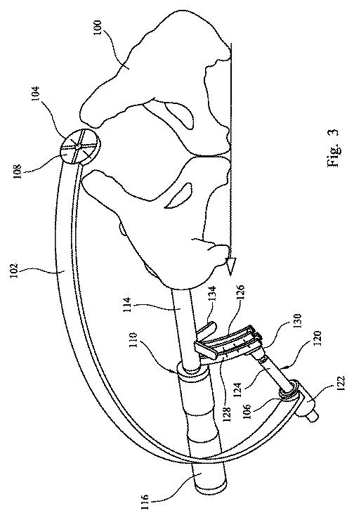 2019521806-股関節置換手術において使用される器具アセンブリ 図000005
