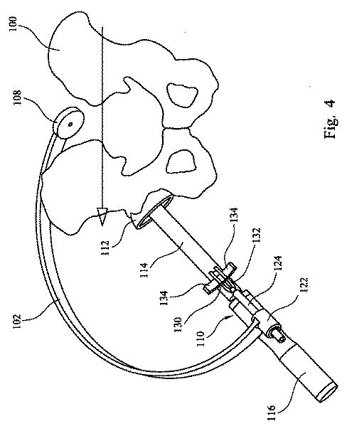 2019521806-股関節置換手術において使用される器具アセンブリ 図000006