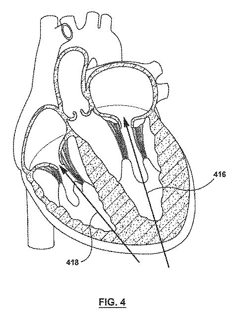 2020501633-原位置で腱索を管理するための一体型変位構成要素を有する弁送達システム、及びその使用方法 図000006