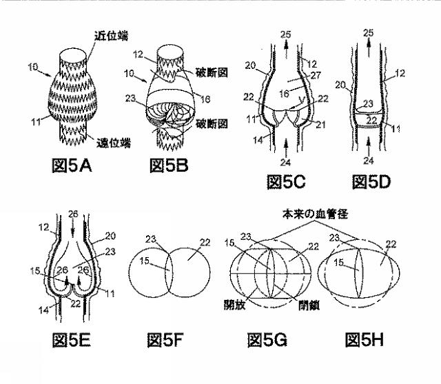 2018530386-植え込み可能弁及び方法 図000007