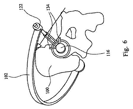 2019521806-股関節置換手術において使用される器具アセンブリ 図000008