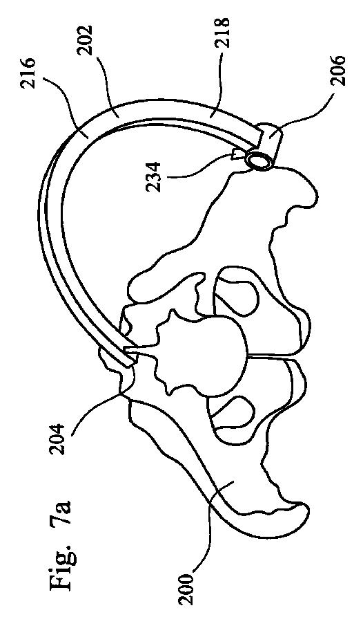 2019521806-股関節置換手術において使用される器具アセンブリ 図000009