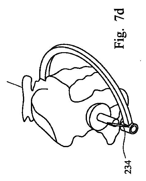 2019521806-股関節置換手術において使用される器具アセンブリ 図000012
